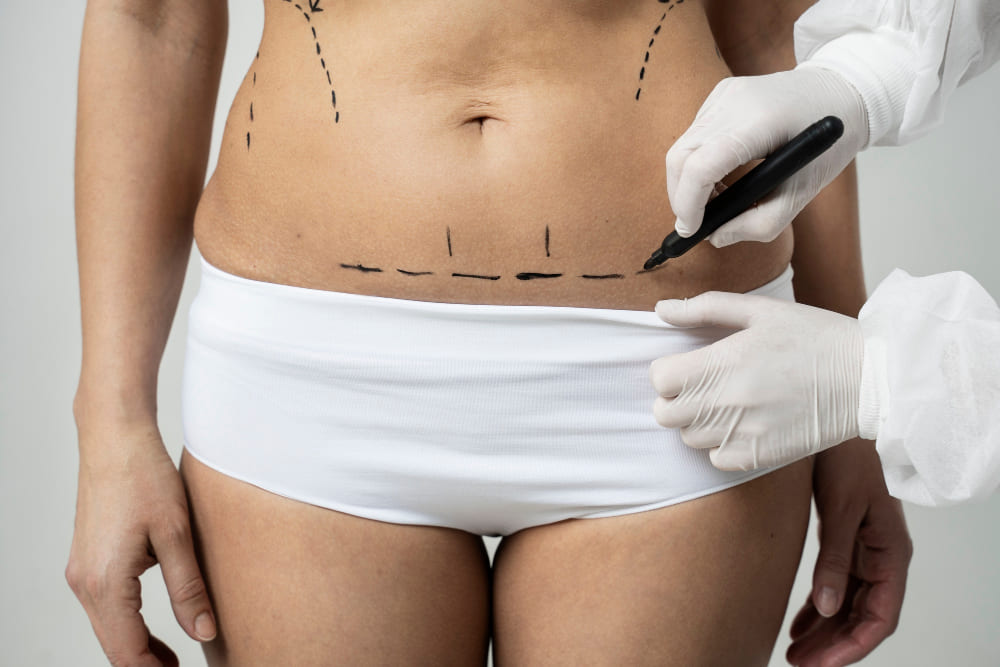 Tummy tuck